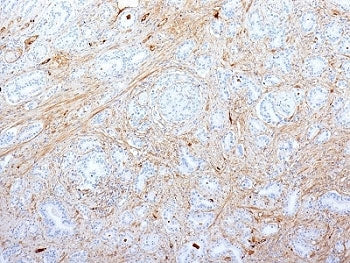 IHC: Formalin-fixed, paraffin-embedded human pancreatic adenocarcinoma stained with Fibronectin anti
