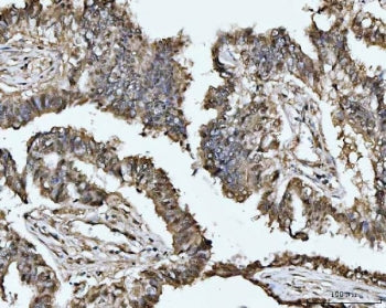 IHC staining of FFPE human lung adenocarcinoma tissue with MAT2A antibody. HIER: boil tissue section