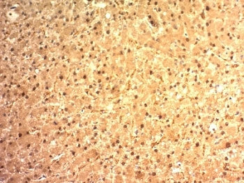 IHC: Formalin-fixed, paraffin-embedded human hepatocellular carcinoma stained with Arginase 1 antibo