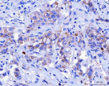 IHC staining of FFPE human breast cancer tissue with DSG2 antibody. HIER: boil tissue sections in pH