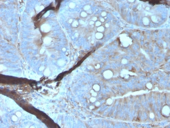 IHC staining of FFPE human colon carcinoma tissue with MERTK antibody (clone MERTK/3023). HIER: boil