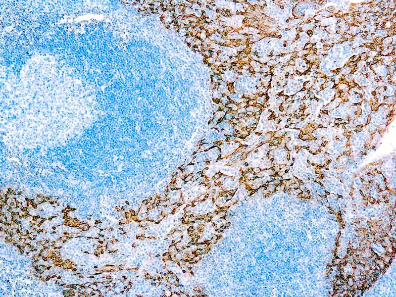 Cytokeratin 5 & 14