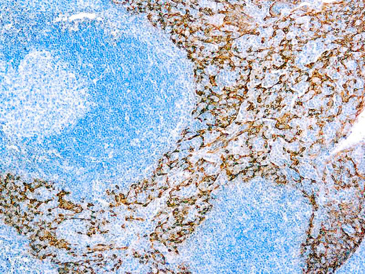 Cytokeratin 5 & 14