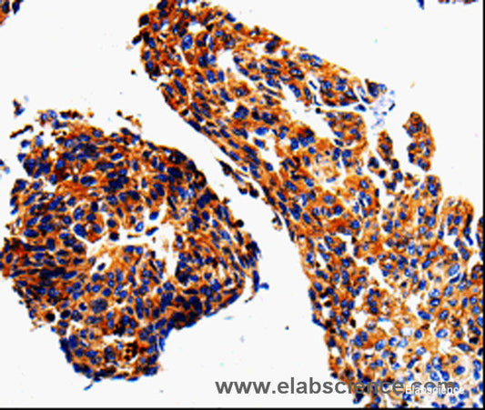 Immunohistochemistry of paraffin-embedded Human lung cancer tissue using ADD1 Polyclonal Antibody at dilution 1:50