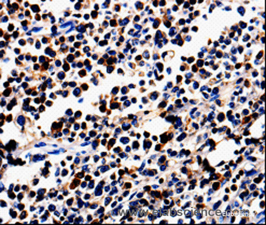 Immunohistochemistry of paraffin-embedded Human colon cancer tissue using ALOX5 Polyclonal Antibody at dilution 1:50