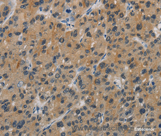 Immunohistochemistry of paraffin-embedded Human liver cancer tissue using CASP9 Polyclonal Antibody at dilution 1:60