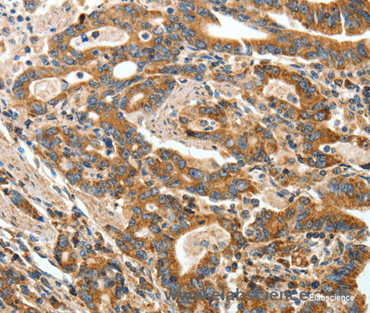 Immunohistochemistry of paraffin-embedded Human gasrtic cancer tissue using ANGPTL1 Polyclonal Antibody at dilution 1:40