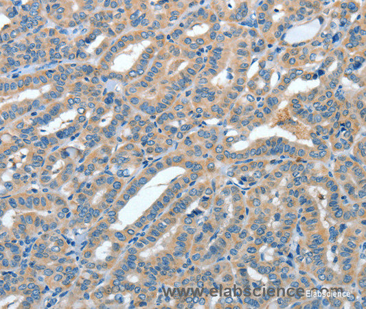 Immunohistochemistry of paraffin-embedded Human thyroid cancer tissue using ANGPT1 Polyclonal Antibody at dilution 1:50
