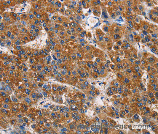 Immunohistochemistry of paraffin-embedded Human liver cancer tissue using APLNR Polyclonal Antibody at dilution 1:50