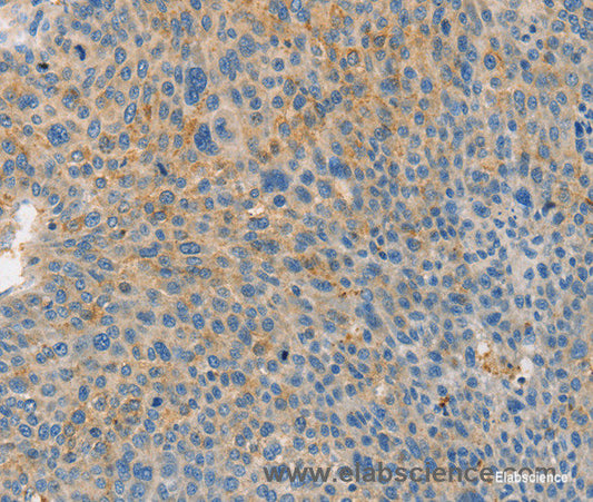 Immunohistochemistry of paraffin-embedded Human liver cancer tissue using BRCA1 Polyclonal Antibody at dilution 1:35