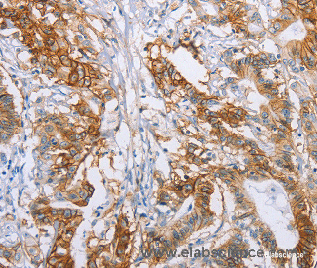 Immunohistochemistry of paraffin-embedded Human colon cancer tissue using CA9 Polyclonal Antibody at dilution 1:50