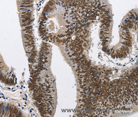 Immunohistochemistry of paraffin-embedded Human colon cancer tissue using CMTM2 Polyclonal Antibody at dilution 1:60