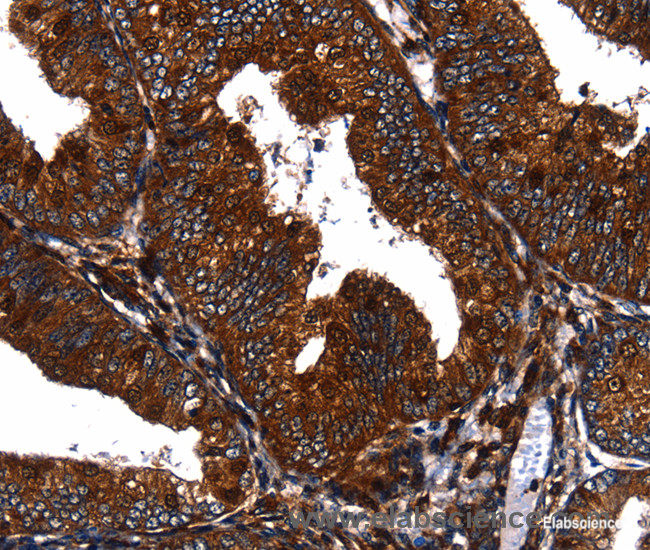 Immunohistochemistry of paraffin-embedded Human cervical cancer tissue using EGF Polyclonal Antibody at dilution 1:60