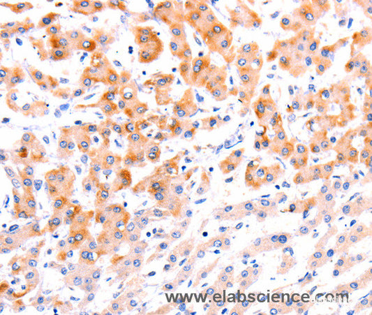 Immunohistochemistry of paraffin-embedded Human liver cancer tissue using Ephrin A1 Polyclonal Antibody at dilution 1:37