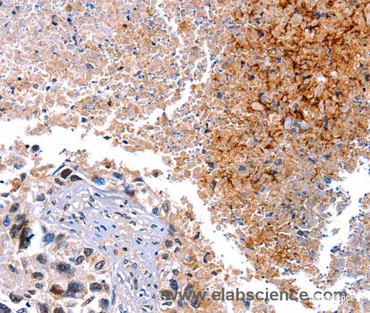 Immunohistochemistry of paraffin-embedded Human lung cancer tissue using HMOX1 Polyclonal Antibody at dilution 1:40