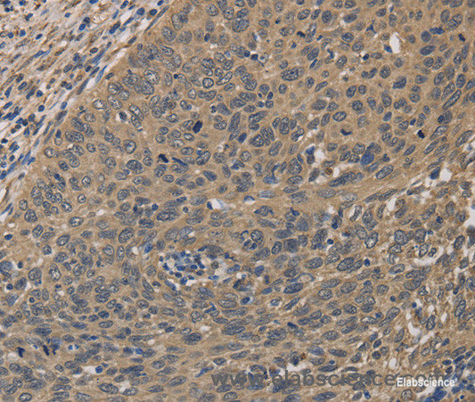 Immunohistochemistry of paraffin-embedded Human cervical cancer tissue using HSF1 Polyclonal Antibody at dilution 1:60