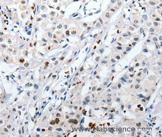 Immunohistochemistry of paraffin-embedded Human lung cancer tissue using HSPA1A Polyclonal Antibody at dilution 1:60