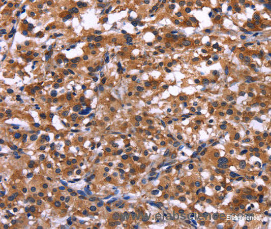 Immunohistochemistry of paraffin-embedded Human thyroid cancer tissue using IL1A Polyclonal Antibody at dilution 1:40