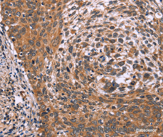 Immunohistochemistry of paraffin-embedded Human cervical cancer tissue using ING2 Polyclonal Antibody at dilution 1:60