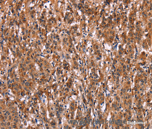 Immunohistochemistry of paraffin-embedded Human gasrtic cancer tissue using LILRB1 Polyclonal Antibody at dilution 1:50