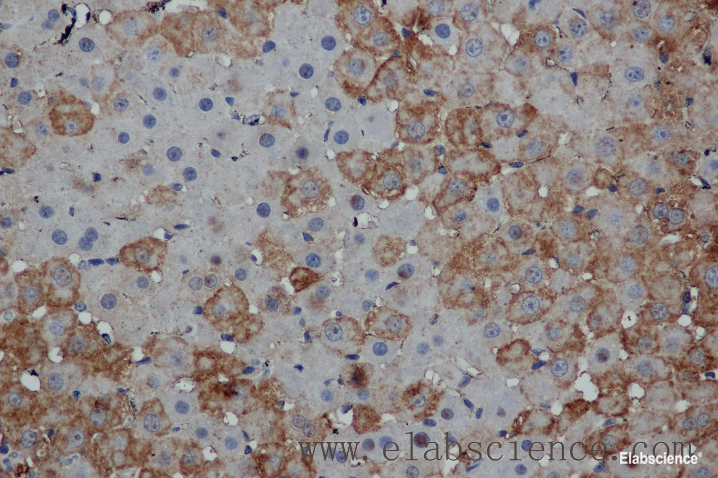 Immunohistochemistry of paraffin-embedded Human thyroid cancer tissue using MPO Polyclonal Antibody at dilution 1:50