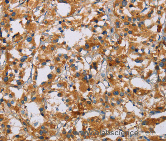Immunohistochemistry of paraffin-embedded Human thyroid cancer tissue using NRN1 Polyclonal Antibody at dilution of 1:40