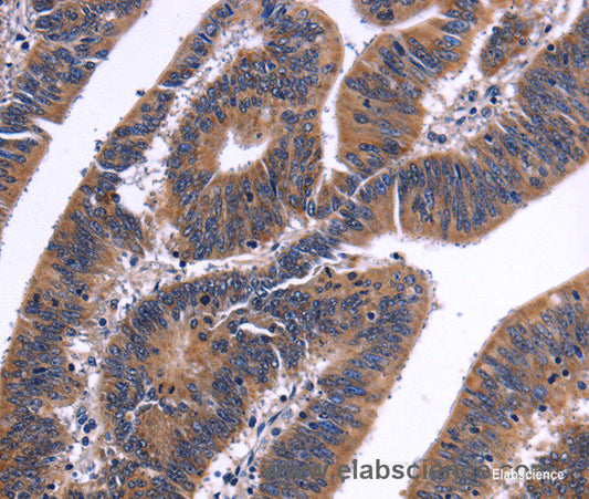 Immunohistochemistry of paraffin-embedded Human colon cancer tissue using NFATC3 Polyclonal Antibody at dilution 1:50