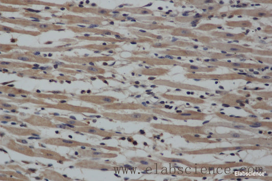 Immunohistochemistry of paraffin-embedded Human gasrtic cancer tissue using NOS2 Polyclonal Antibody at dilution 1:40