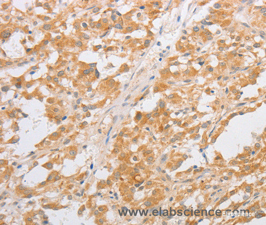 Immunohistochemistry of paraffin-embedded Human thyroid cancer tissue using CDKN2AIP Polyclonal Antibody at dilution 1:40