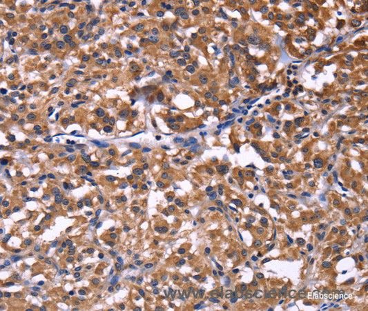 Immunohistochemistry of paraffin-embedded Human thyroid cancer tissue using SELPLG Polyclonal Antibody at dilution 1:50