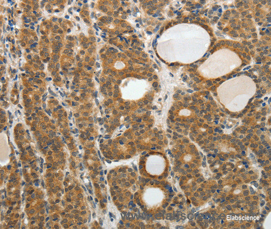 Immunohistochemistry of paraffin-embedded Human thyroid cancer tissue using RARA Polyclonal Antibody at dilution 1:40