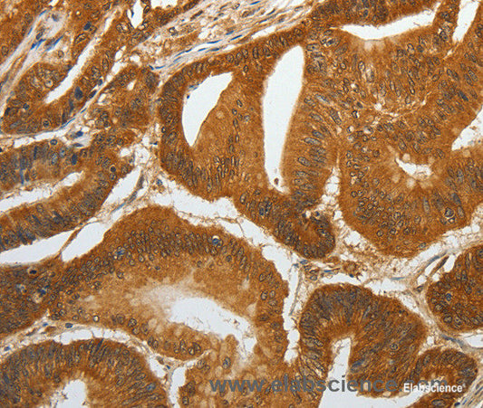 Immunohistochemistry of paraffin-embedded Human colon cancer tissue using RETNLB Polyclonal Antibody at dilution 1:40