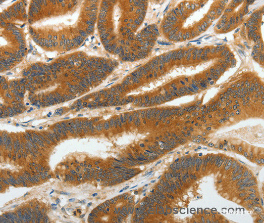 Immunohistochemistry of paraffin-embedded Human colon cancer tissue using RGS2 Polyclonal Antibody at dilution 1:40