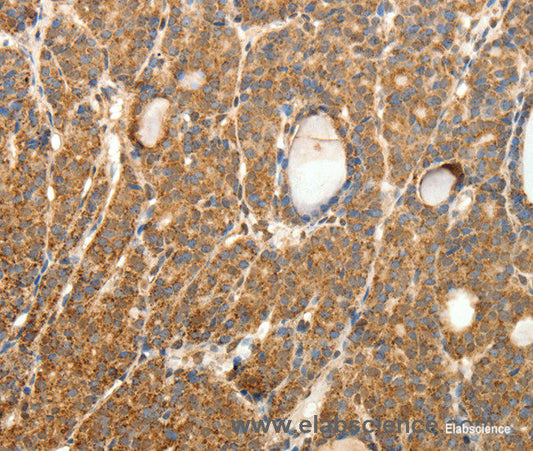 Immunohistochemistry of paraffin-embedded Human thyroid cancer tissue using SYT11 Polyclonal Antibody at dilution 1:30