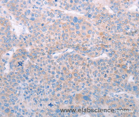 Immunohistochemistry of paraffin-embedded Human liver cancer tissue using SPATA6 Polyclonal Antibody at dilution 1:50