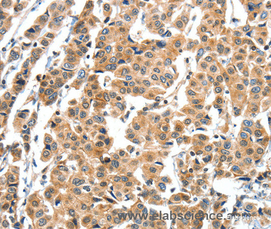Immunohistochemistry of paraffin-embedded Human breast cancer tissue using XBP1 Polyclonal Antibody at dilution 1:60