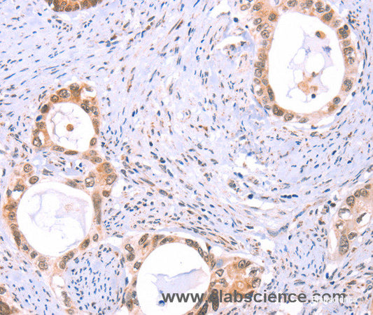 Immunohistochemistry of paraffin-embedded Human cervical cancer tissue using PROS1 Polyclonal Antibody at dilution 1:60