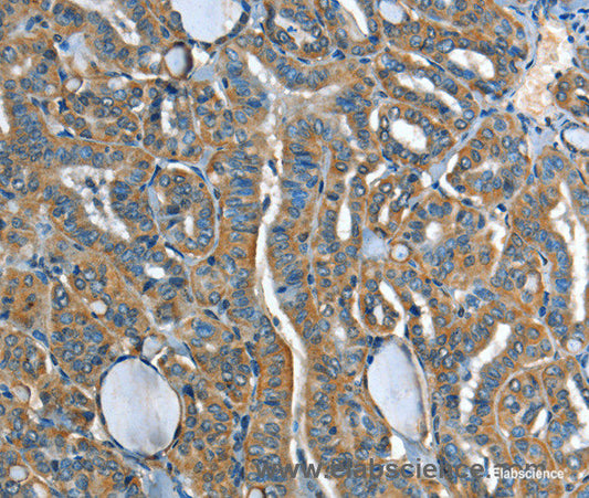 Immunohistochemistry of paraffin-embedded Human thyroid cancer tissue using ADCY4 Polyclonal Antibody at dilution 1:45