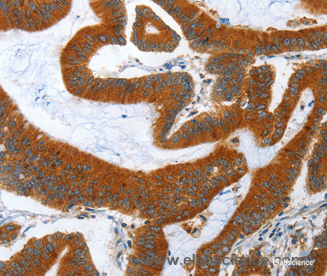 Immunohistochemistry of paraffin-embedded Human colon cancer tissue using ANAPC10 Polyclonal Antibody at dilution 1:40