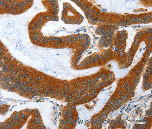 Immunohistochemistry of paraffin-embedded Human colon cancer tissue using ANAPC10 Polyclonal Antibody at dilution 1:40