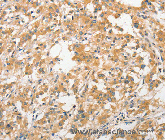 Immunohistochemistry of paraffin-embedded Human thyroid cancer tissue using APC5 Polyclonal Antibody at dilution 1:30