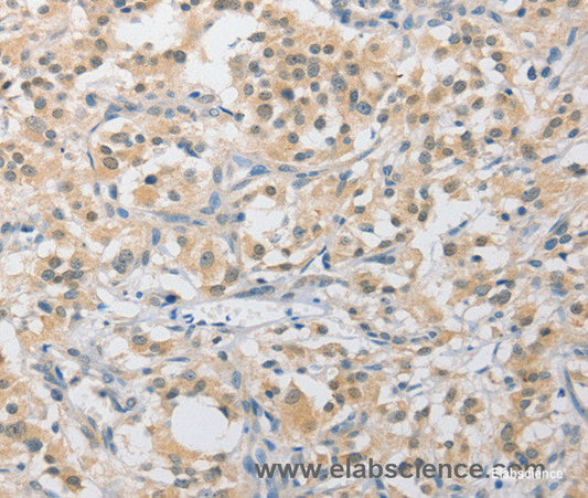 Immunohistochemistry of paraffin-embedded Human thyroid cancer tissue using APLF Polyclonal Antibody at dilution 1:40
