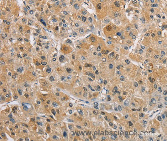 Immunohistochemistry of paraffin-embedded Human liver cancer tissue using NAPSA Polyclonal Antibody at dilution 1:40