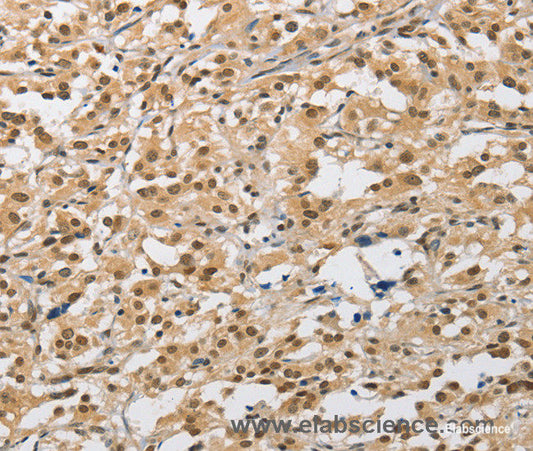 Immunohistochemistry of paraffin-embedded Human thyroid cancer tissue using AMZ2 Polyclonal Antibody at dilution 1:40