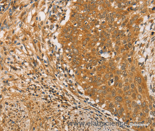 Immunohistochemistry of paraffin-embedded Human cervical cancer tissue using ARMCX3 Polyclonal Antibody at dilution 1:40