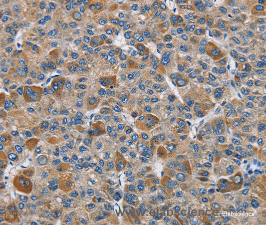 Immunohistochemistry of paraffin-embedded Human liver cancer tissue using DNMT3A Polyclonal Antibody at dilution 1:50
