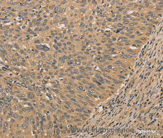 Immunohistochemistry of paraffin-embedded Human cervical cancer tissue using PRDM14 Polyclonal Antibody at dilution 1:30