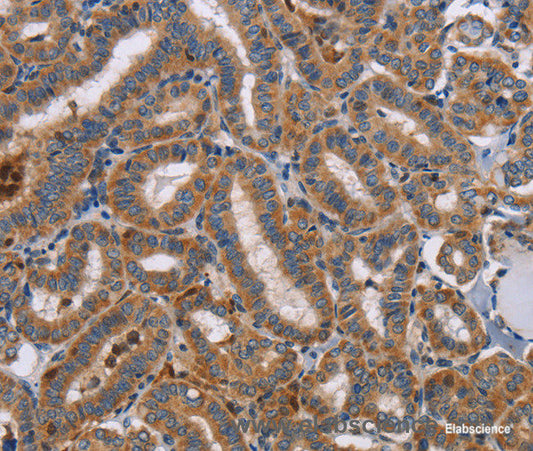 Immunohistochemistry of paraffin-embedded Human thyroid cancer tissue using TLR8 Polyclonal Antibody at dilution 1:40