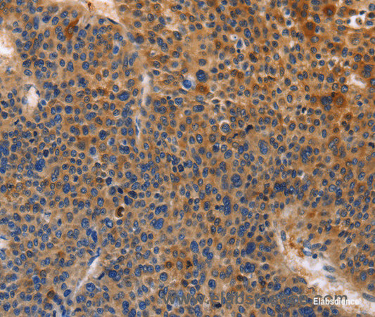Immunohistochemistry of paraffin-embedded Human liver cancer tissue using MUSK Polyclonal Antibody at dilution of 1:30