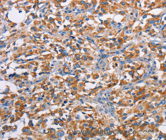 Immunohistochemistry of paraffin-embedded Human thyroid cancer tissue using PIM2 Polyclonal Antibody at dilution 1:40